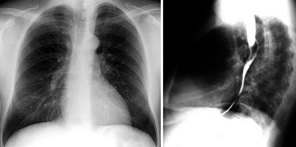 normales Röntgen